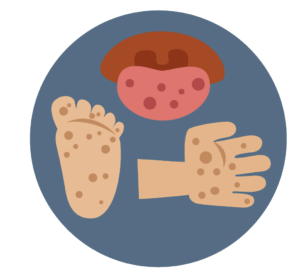 Hand Foot Mouth Disease